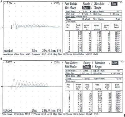 Congenital Myasthenic Syndrome in a Mixed Breed Dog